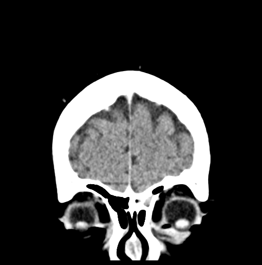 Cerebellar metastasis (Radiopaedia 54578-60812 Coronal C+ 7).png