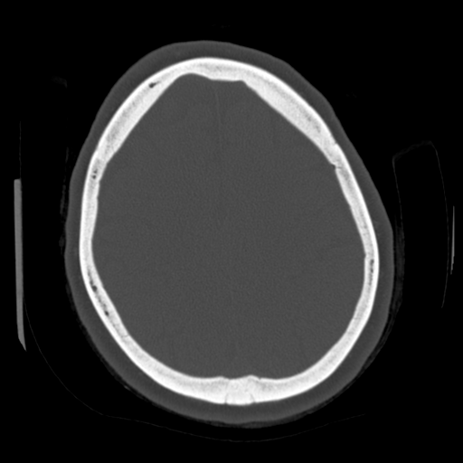 Cerebellar metastasis (cystic appearance) (Radiopaedia 41395-44258 Axial bone window 52).png