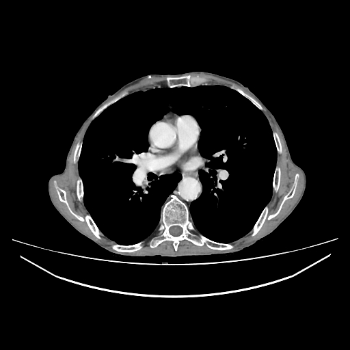 Cerebellar metastasis - lung tumor (Radiopaedia 69317-79150 A 18).jpg