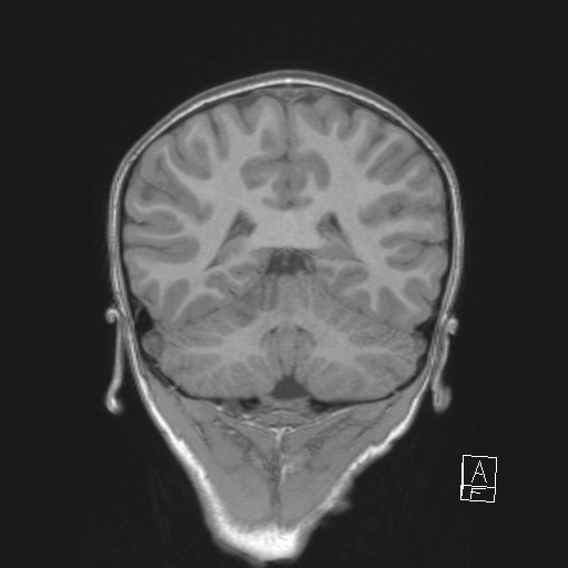 Cerebellar stroke (Radiopaedia 32202-33150 Coronal T1 41).png