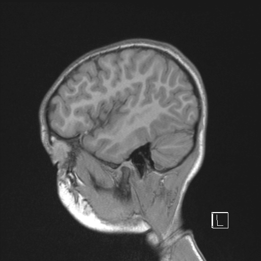 Cerebellar stroke (Radiopaedia 32202-33150 Sagittal T1 C+ 42).png