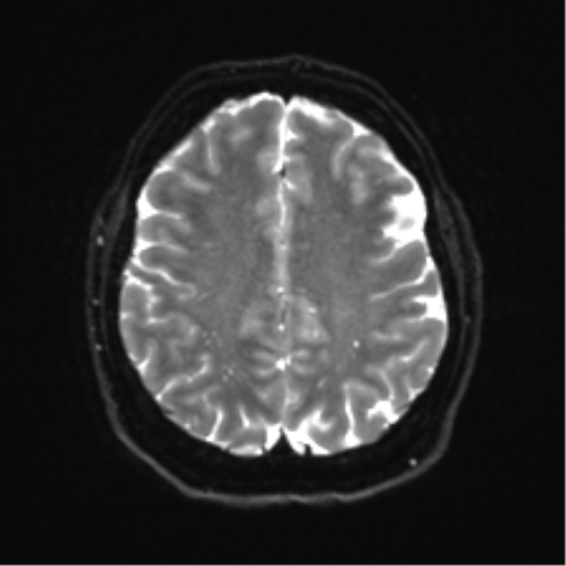 Cerebellopontine angle meningioma (Radiopaedia 48434-53348 Axial DWI 28).png