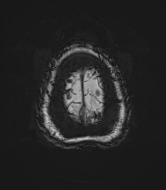 Cerebellopontine angle meningioma (Radiopaedia 48434-53348 Axial SWI 88).png