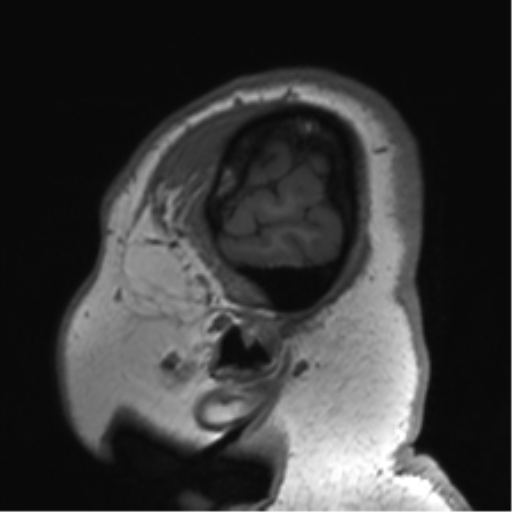 Cerebellopontine angle meningioma (Radiopaedia 48434-53348 Sagittal T1 82).png