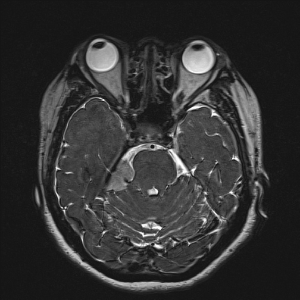 File:Cerebellopontine angle meningioma (Radiopaedia 53561-59591 Axial 3D volume T2 78).jpg