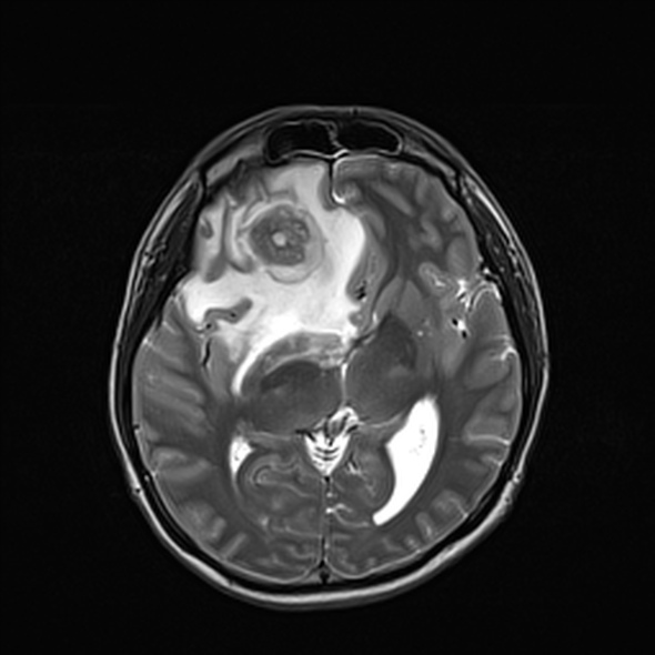 Cerebral abscess (Radiopaedia 24212-24478 Axial T2 31).jpg