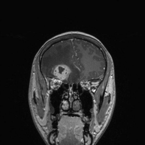 Cerebral abscess (Radiopaedia 24212-24478 Coronal T1 C+ 65).jpg