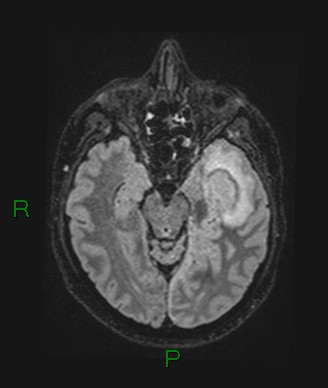 File:Cerebral abscess and subdural empyema (Radiopaedia 84436-99779 Axial FLAIR 53).jpg