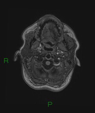 Cerebral abscess and subdural empyema (Radiopaedia 84436-99779 Axial T1 82).jpg
