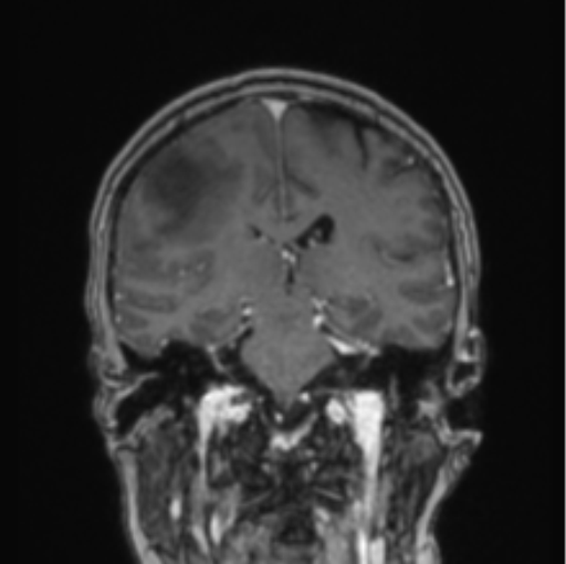 File:Cerebral abscess from pulmonary arteriovenous malformation (Radiopaedia 86275-102291 L 41).png