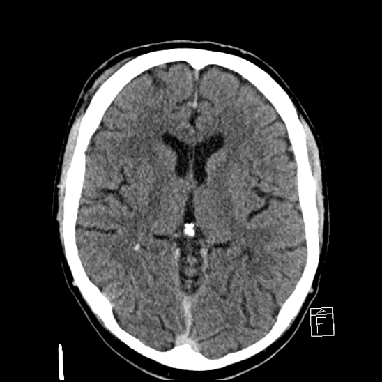 File:Cerebral abscess with ventriculitis (Radiopaedia 78965-91877 A 24).jpg