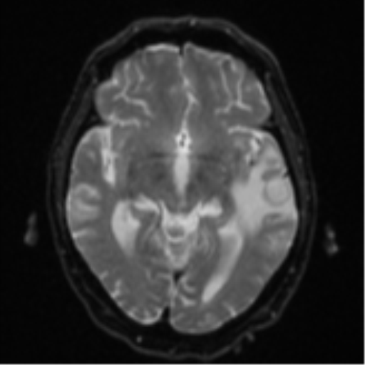 Cerebral abscesses- medically managed (Radiopaedia 45183-49179 Axial DWI 13).png
