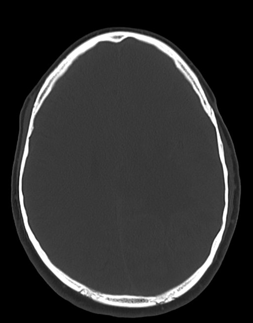 Cerebral abscesses (Radiopaedia 70458-80568 Axial bone window 40).jpg