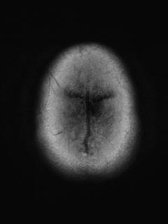 File:Cerebral amyloid angiopathy (Radiopaedia 29129-29518 Axial FLAIR 21).jpg