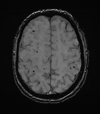 File:Cerebral amyloid angiopathy (Radiopaedia 46082-50433 Axial SWI 62).png