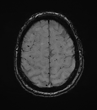 File:Cerebral amyloid angiopathy (Radiopaedia 46082-50433 Axial SWI 69).png