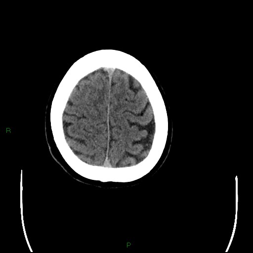 Cerebral amyloid angiopathy (Radiopaedia 77506-89665 Axial non-contrast 95).jpg
