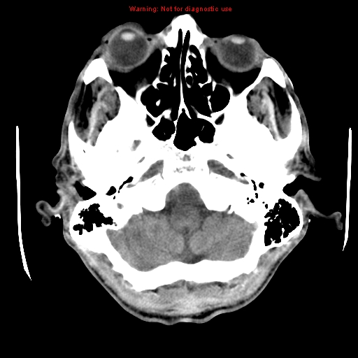 File:Cerebral and orbital tuberculomas (Radiopaedia 13308-13310 Axial non-contrast 5).jpg