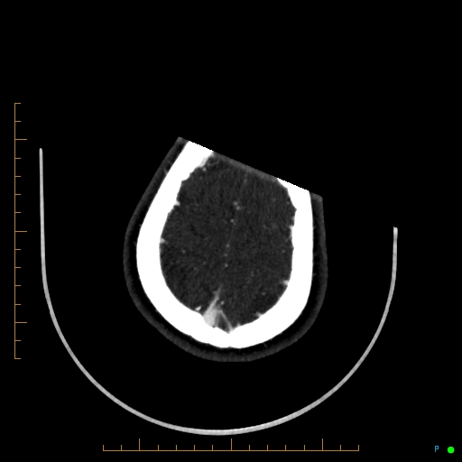 Cerebral arteriovenous malformation (AVM) (Radiopaedia 78162-90706 Axial CTA 239).jpg