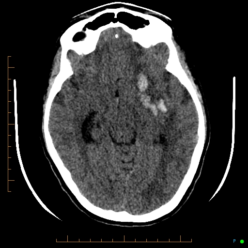 Cerebral arteriovenous malformation (AVM) (Radiopaedia 78162-90706 Axial non-contrast 28).jpg