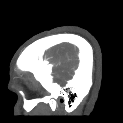 Cerebral arteriovenous malformation (Radiopaedia 39259-41505 Sagittal 8).png