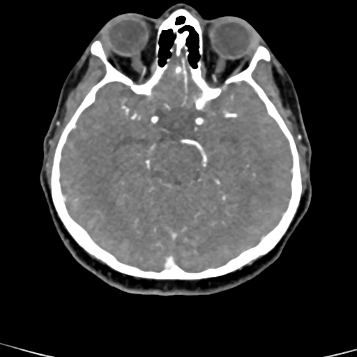 File:Cerebral arteriovenous malformation (Radiopaedia 73830-84645 B 62).jpg