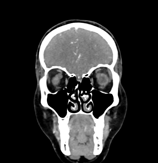 Cerebral arteriovenous malformation (Radiopaedia 73830-84645 C 20).jpg