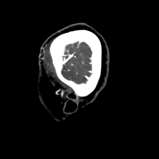 Cerebral arteriovenous malformation (Radiopaedia 73830-84645 Sagittal C+ delayed 5).jpg
