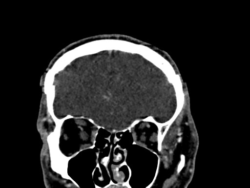 Cerebral arteriovenous malformation (Radiopaedia 78188-90746 Coronal C+ delayed 19).jpg