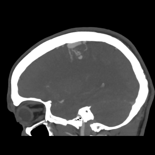 Cerebral arteriovenous malformation (Spetzler-Martin grade 2) (Radiopaedia 41262-44076 G 18).png