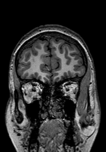 File:Cerebral arteriovenous malformation at posterior body of corpus callosum (Radiopaedia 74111-84925 Coronal T1 39).jpg