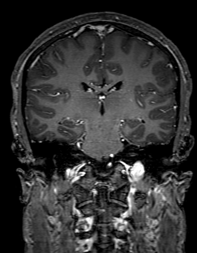 Cerebral arteriovenous malformation at posterior body of corpus callosum (Radiopaedia 74111-84925 K 208).jpg