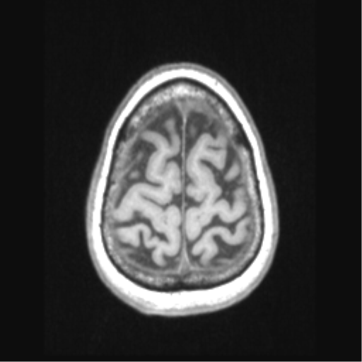 Cerebral arteriovenous malformation with hemorrhage (Radiopaedia 34422-35737 Axial T1 67).png
