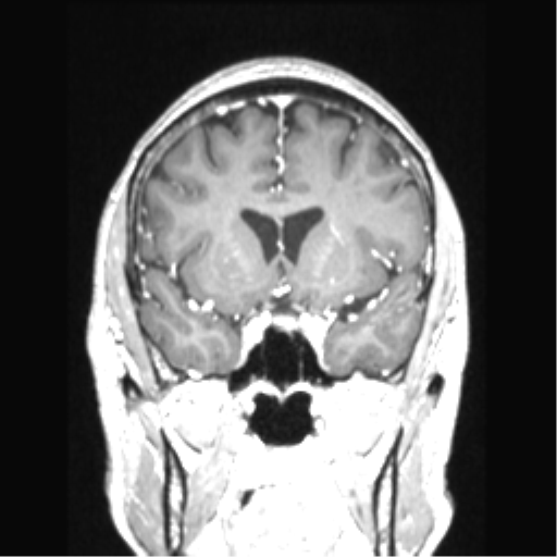 Cerebral arteriovenous malformation with hemorrhage (Radiopaedia 34422-35737 Coronal T1 C+ 59).png