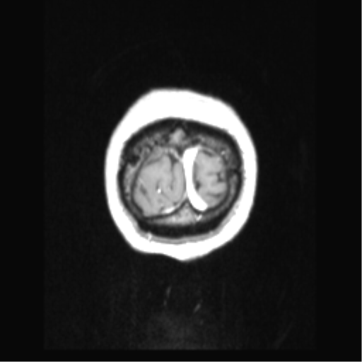 Cerebral arteriovenous malformation with hemorrhage (Radiopaedia 34422-35737 Coronal T1 C+ 6).png