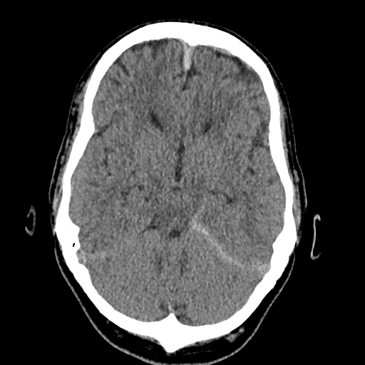 Cerebral arteriovenous malformation with lobar hemorrhage (Radiopaedia 35598-37117 Axial non-contrast 19).jpg