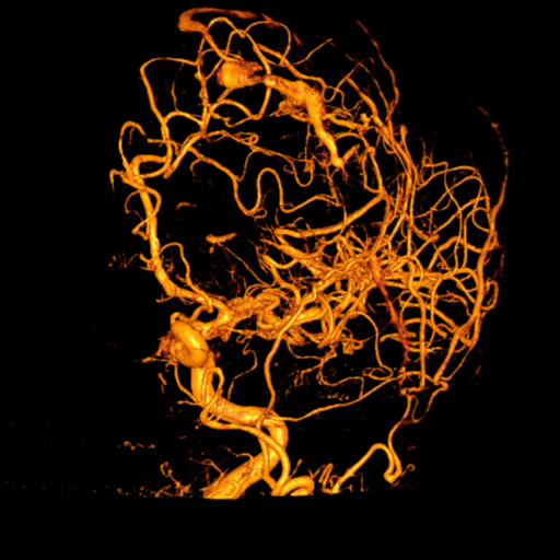 Cerebral arteriovenous malformation with lobar hemorrhage (Radiopaedia 44725-48513 C 49).png