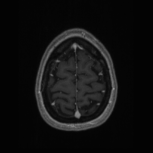 Cerebral cavernoma and development venous anomaly (Radiopaedia 37603-39482 Axial T1 C+ 67).png