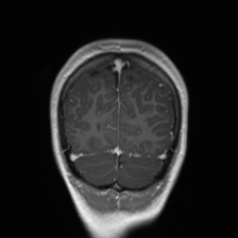 Cerebral cavernous venous malformation (Radiopaedia 70008-80021 Coronal T1 C+ 11).jpg