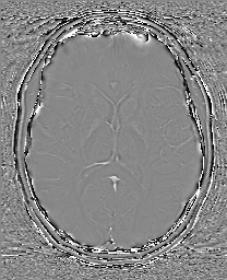 Cerebral cavernous venous malformation (Radiopaedia 70008-80021 G 40).jpg