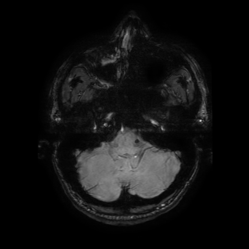 Cerebral cavernous venous malformation (Zabramski type II) (Radiopaedia 85511-101198 Axial SWI 27).jpg