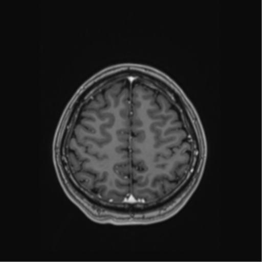 Cerebral cavernous venous malformations (Radiopaedia 48117-52946 Axial T1 C+ 51).png