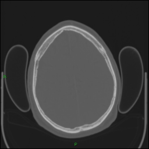 Cerebral contusions (Radiopaedia 33868-35039 Axial bone window 161).jpg