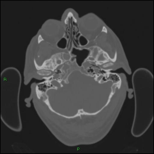 File:Cerebral contusions (Radiopaedia 33868-35039 Axial bone window 32).jpg