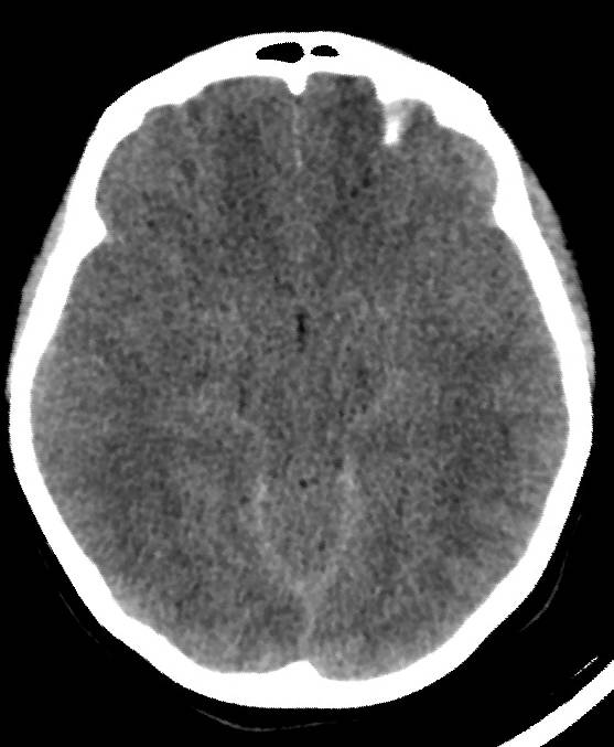 Cerebral edema due to severe hyponatremia (Radiopaedia 89826-106937 Axial non-contrast 38).jpg