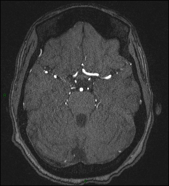 Cerebral fat embolism (Radiopaedia 35022-36525 Axial TOF 69).jpg