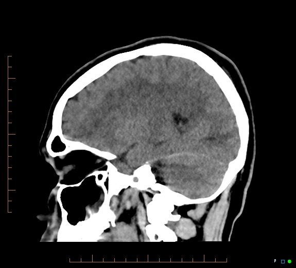 Cerebral fat embolism (Radiopaedia 85521-101220 B 35).jpg