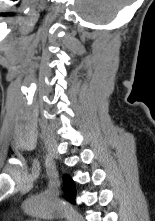 Cerebral hemorrhagic contusions and cervical spine fractures (Radiopaedia 32865-33841 G 42).jpg