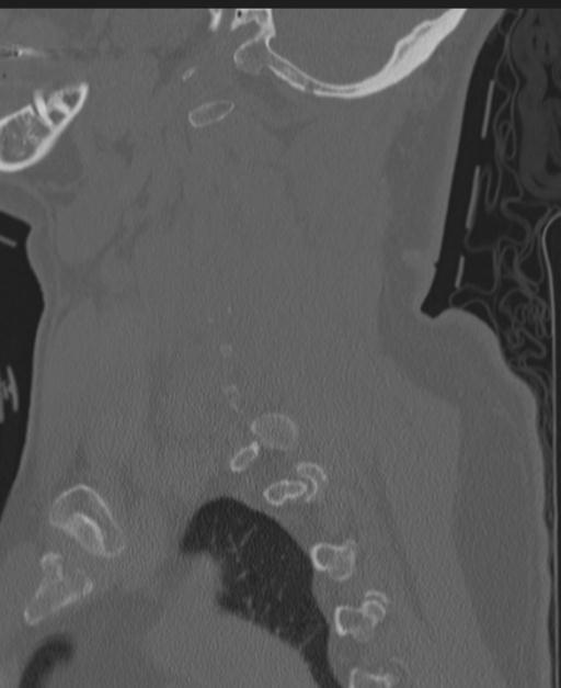 Cerebral hemorrhagic contusions and cervical spine fractures (Radiopaedia 32865-33841 Sagittal bone window 29).jpg