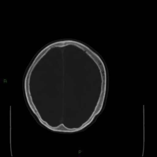File:Cerebral metastases - breast primary (Radiopaedia 77653-89857 Axial bone window 89).jpg